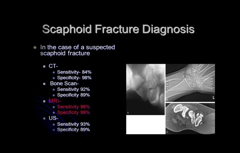 Scaphoid Fracture Diagnosis