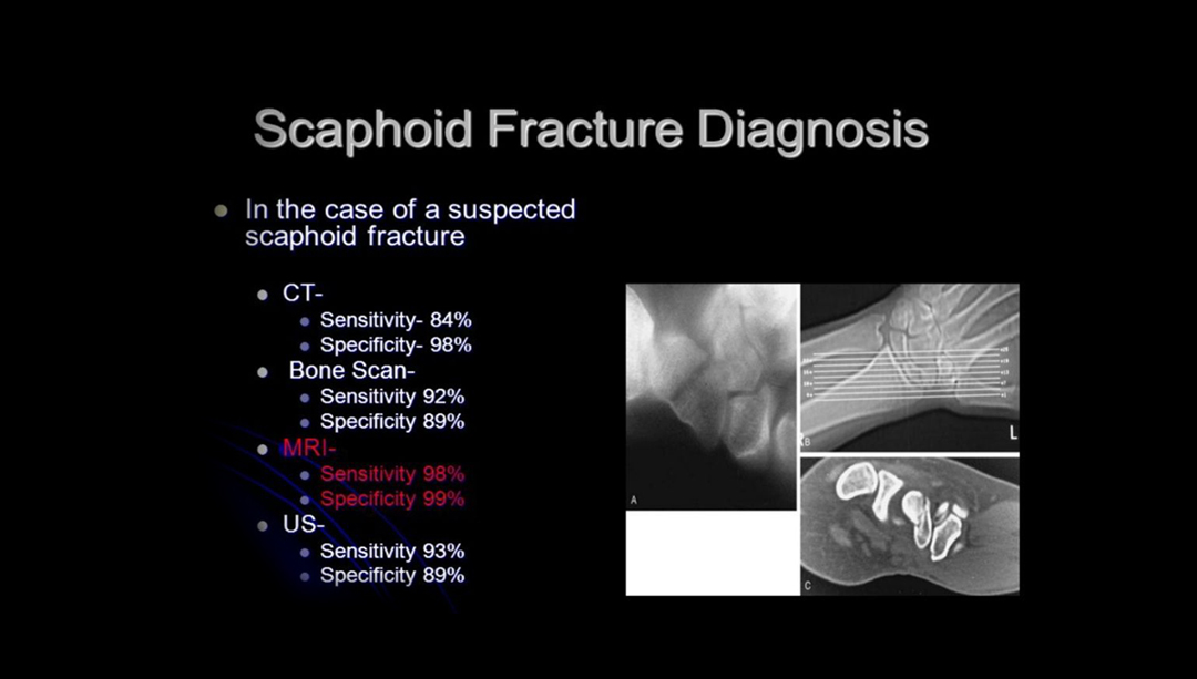 Scaphoid Fracture Diagnosis telepatron