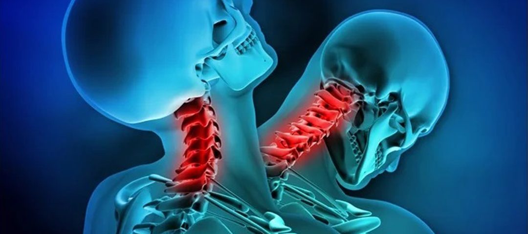 whiplash syndrome