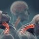 Whiplash Syndrome