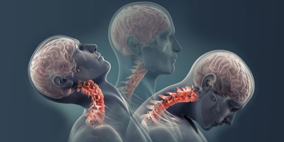 Whiplash Syndrome