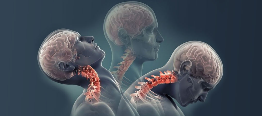 Whiplash Syndrome