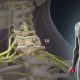 Radiculopathy VS Neuropathy