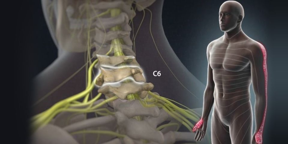 Radiculopathy VS Neuropathy