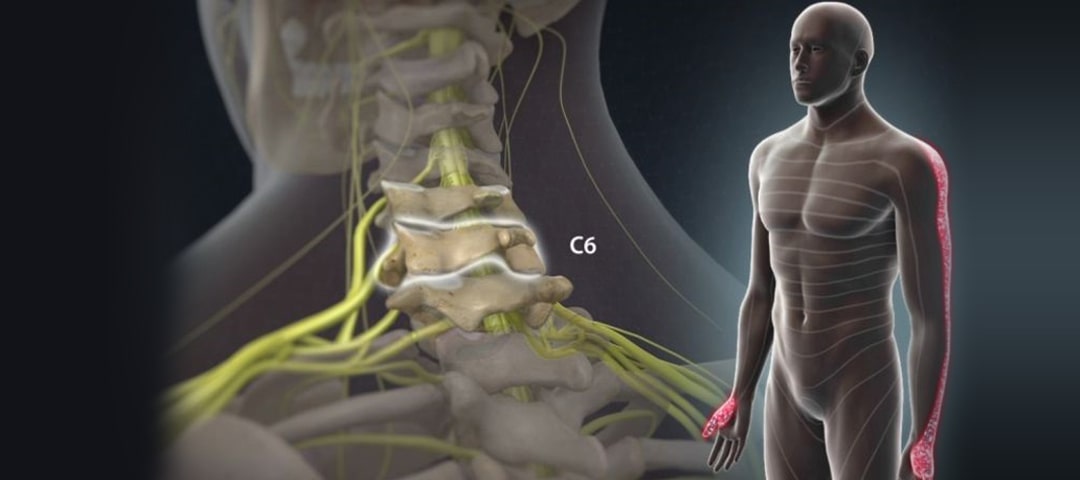 Radiculopathy VS Neuropathy