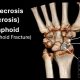 Scaphoid Fracture