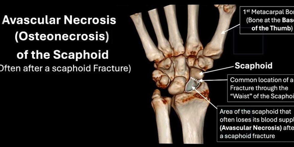 Scaphoid Fracture