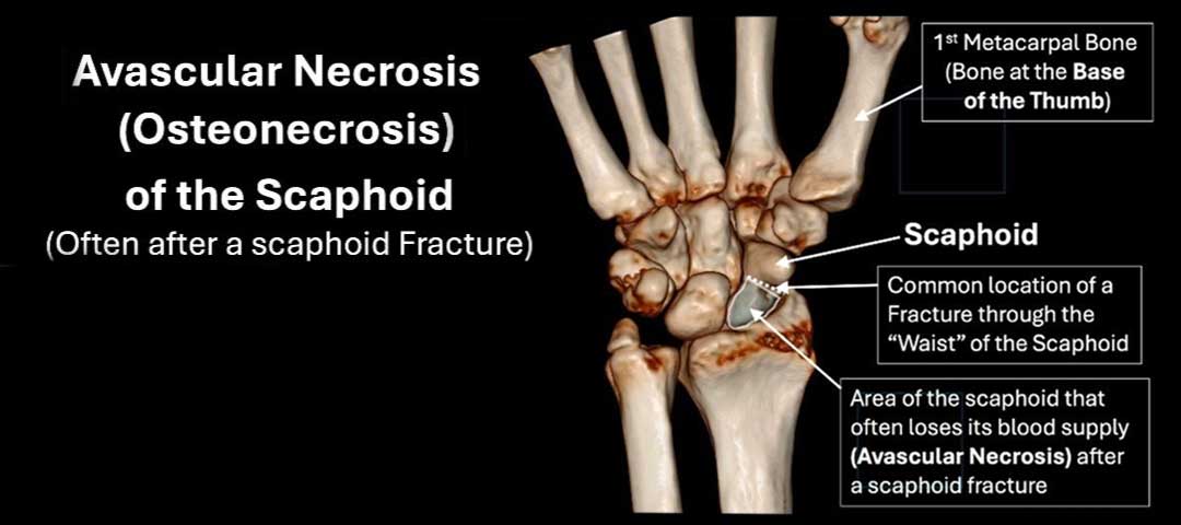Scaphoid Fracture