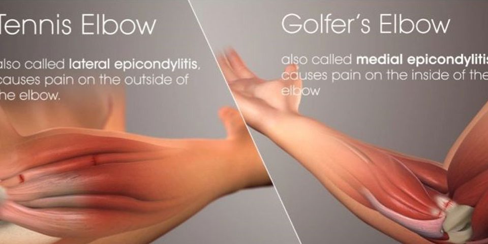 Tennis And Golfer Elbow