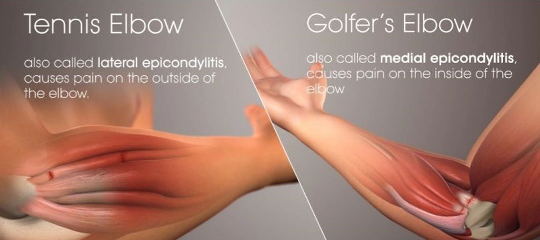 Tennis And Golfer Elbow