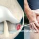 Meniscus Tear