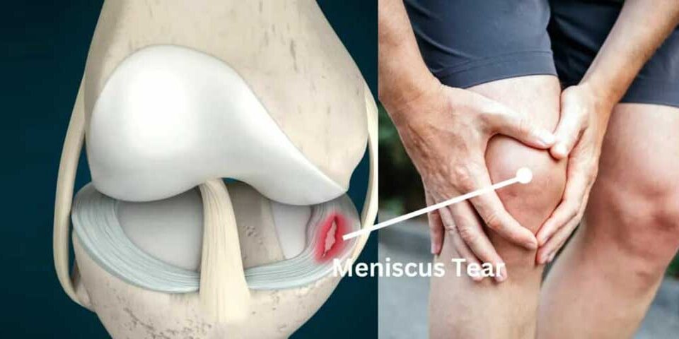 Meniscus Tear