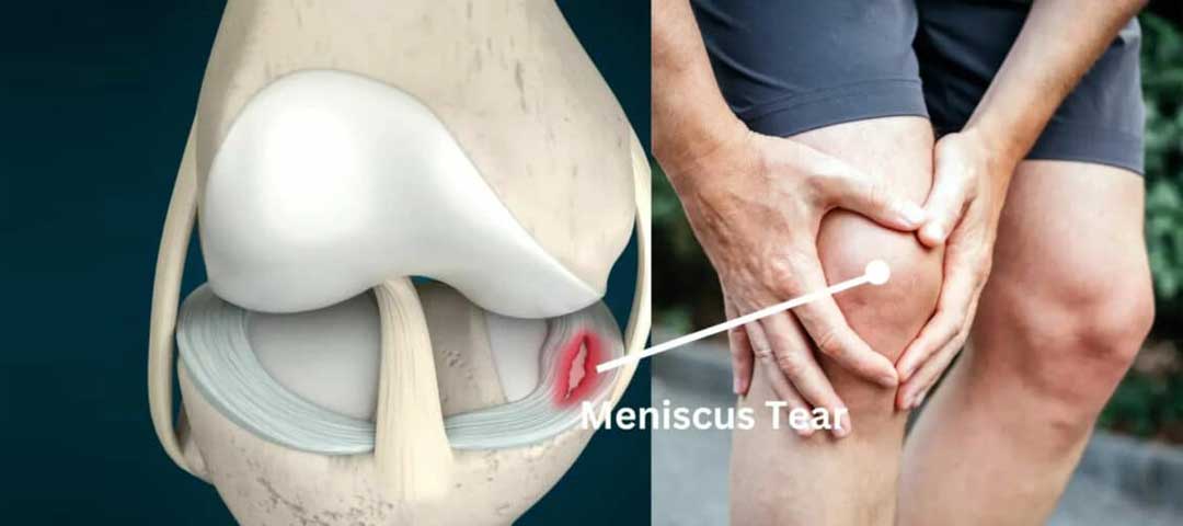 Meniscus Tear